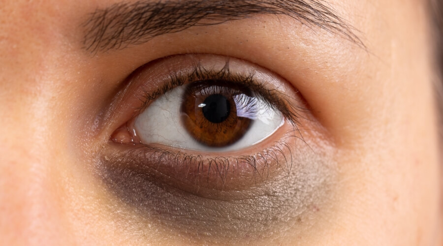 الهالات السوداء